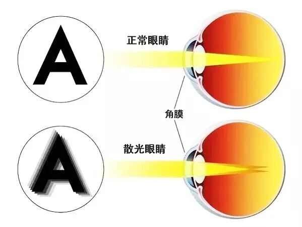 囿乐学U1光营养近视管理镜片为孩子眼睛有散光设计